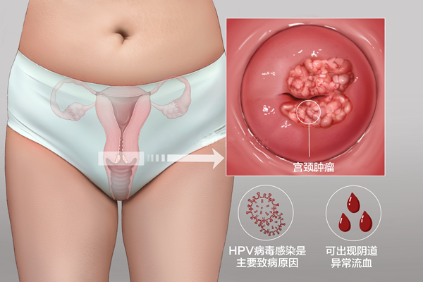 已经感染了HPV,怎么办？